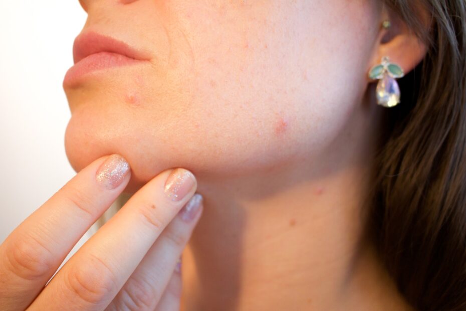 Home Remedies For Acne - Acne Treatment
